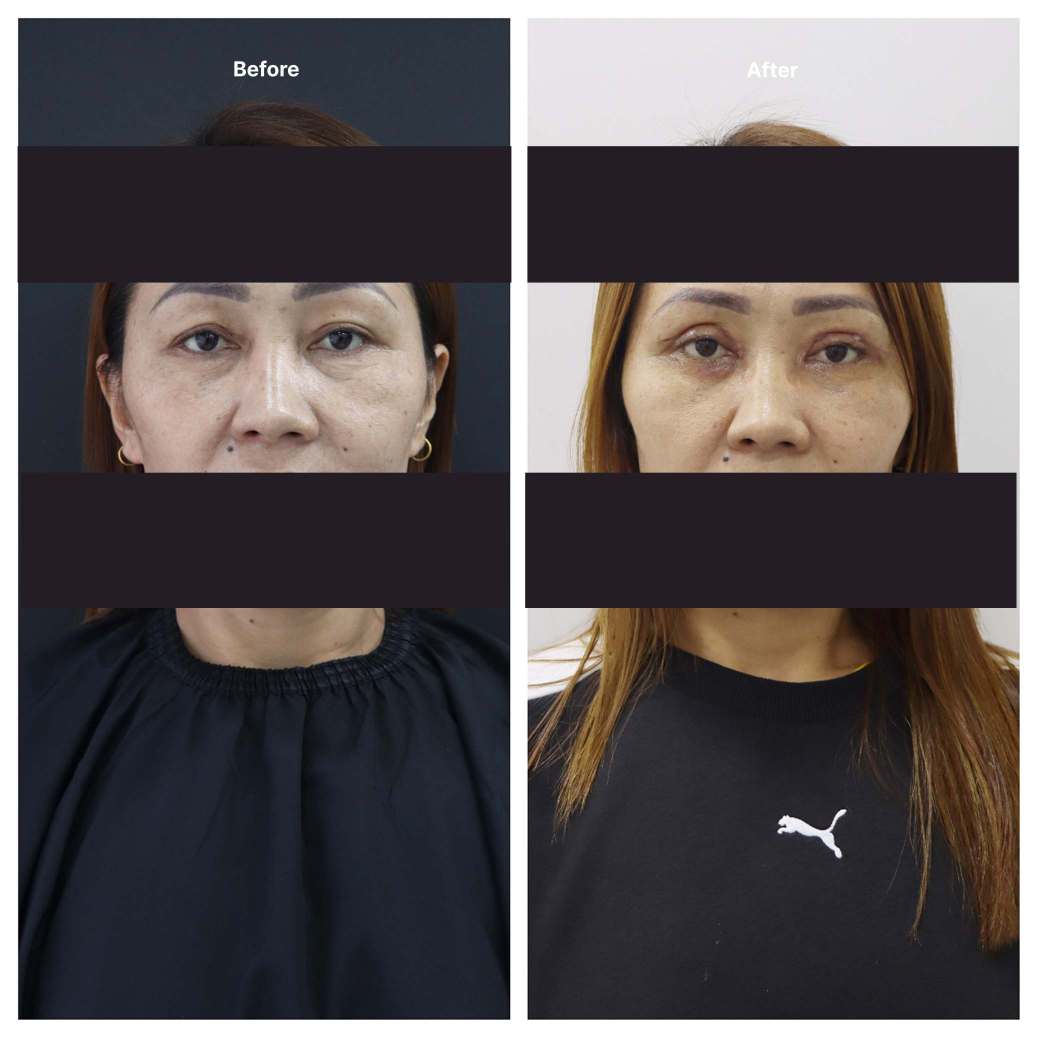 Eyelid Surgery KOQ10